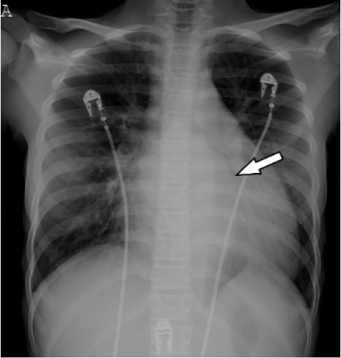 (A) Chest radiograph shows cardiomegaly and an abnormal left paraspinal density in the region of the descending thoracic aorta (arrow). (B, C and D) Coronal contrast-enhanced computed tomographic angiography images of the chest, abdomen and pelvis reveal a diffuse abnormal appearance of the descending thoracic aorta and suprarenal abdominal aorta with lumen irregularity, wall thickening and/or mural thrombus as well as multiple aneurysms (arrowheads). Lack of contrast opacification of the left renal artery and delayed enhancement of the left kidney (white arrow) secondary to renal artery stenosis or thrombosis.