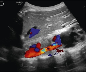 (A,B,C,D) Transverse and sagittal gray-scale and color Doppler ultrasound images of the upper abdominal aorta (white arrow) and (E,F) transverse gray-scale and color Doppler ultrasound images of the superior mesenteric artery (black arrow) show wall thickening and/or mural thrombus, lumen irregularity, and multiple aneurysms. (G,H) Transverse Gray-scale and color Doppler ultrasound images of the abdominal aorta and left renal artery (yellow arrow) show ostial narrowing of the left renal artery.