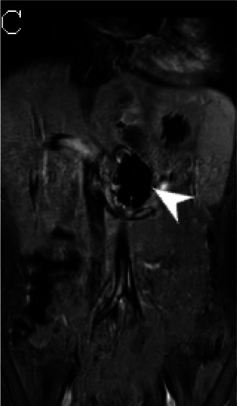 (A) Axial triggered angiography non-contrast enhanced (TRANCE) MRI sequence shows suprarenal abdominal aortic aneurysm (star) and marked decreased signal intensity of the left renal parenchyma (arrow) compared to the right consistent with renal ischemia secondary to decreased perfusion. (B) Axial echo-planar image (EPI) MRI image and (C) Coronal EPI post-contrast MRI image reveal non-enhancing aortic wall thickening (black arrow head) suggesting wall edema and/or mural thrombus. There is also undulating contour of the aortic lumen with saccular dilatation (white arrow head). (D) 3-D reconstructed image reveals the luminal irregularity and aneurysms of the thoraco-abdominal aorta.