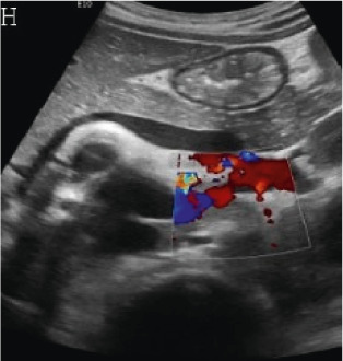 (A,B,C,D) Transverse and sagittal gray-scale and color Doppler ultrasound images of the upper abdominal aorta (white arrow) and (E,F) transverse gray-scale and color Doppler ultrasound images of the superior mesenteric artery (black arrow) show wall thickening and/or mural thrombus, lumen irregularity, and multiple aneurysms. (G,H) Transverse Gray-scale and color Doppler ultrasound images of the abdominal aorta and left renal artery (yellow arrow) show ostial narrowing of the left renal artery.