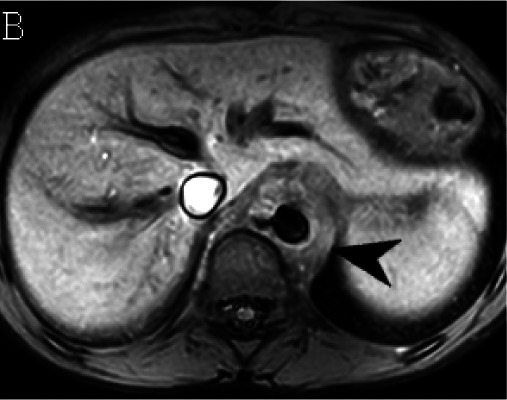 (A) Axial triggered angiography non-contrast enhanced (TRANCE) MRI sequence shows suprarenal abdominal aortic aneurysm (star) and marked decreased signal intensity of the left renal parenchyma (arrow) compared to the right consistent with renal ischemia secondary to decreased perfusion. (B) Axial echo-planar image (EPI) MRI image and (C) Coronal EPI post-contrast MRI image reveal non-enhancing aortic wall thickening (black arrow head) suggesting wall edema and/or mural thrombus. There is also undulating contour of the aortic lumen with saccular dilatation (white arrow head). (D) 3-D reconstructed image reveals the luminal irregularity and aneurysms of the thoraco-abdominal aorta.