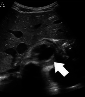 (A,B,C,D) Transverse and sagittal gray-scale and color Doppler ultrasound images of the upper abdominal aorta (white arrow) and (E,F) transverse gray-scale and color Doppler ultrasound images of the superior mesenteric artery (black arrow) show wall thickening and/or mural thrombus, lumen irregularity, and multiple aneurysms. (G,H) Transverse Gray-scale and color Doppler ultrasound images of the abdominal aorta and left renal artery (yellow arrow) show ostial narrowing of the left renal artery.