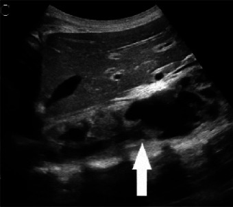 (A,B,C,D) Transverse and sagittal gray-scale and color Doppler ultrasound images of the upper abdominal aorta (white arrow) and (E,F) transverse gray-scale and color Doppler ultrasound images of the superior mesenteric artery (black arrow) show wall thickening and/or mural thrombus, lumen irregularity, and multiple aneurysms. (G,H) Transverse Gray-scale and color Doppler ultrasound images of the abdominal aorta and left renal artery (yellow arrow) show ostial narrowing of the left renal artery.