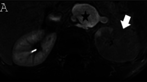 (A) Axial triggered angiography non-contrast enhanced (TRANCE) MRI sequence shows suprarenal abdominal aortic aneurysm (star) and marked decreased signal intensity of the left renal parenchyma (arrow) compared to the right consistent with renal ischemia secondary to decreased perfusion. (B) Axial echo-planar image (EPI) MRI image and (C) Coronal EPI post-contrast MRI image reveal non-enhancing aortic wall thickening (black arrow head) suggesting wall edema and/or mural thrombus. There is also undulating contour of the aortic lumen with saccular dilatation (white arrow head). (D) 3-D reconstructed image reveals the luminal irregularity and aneurysms of the thoraco-abdominal aorta.