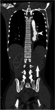 (A) Chest radiograph shows cardiomegaly and an abnormal left paraspinal density in the region of the descending thoracic aorta (arrow). (B, C and D) Coronal contrast-enhanced computed tomographic angiography images of the chest, abdomen and pelvis reveal a diffuse abnormal appearance of the descending thoracic aorta and suprarenal abdominal aorta with lumen irregularity, wall thickening and/or mural thrombus as well as multiple aneurysms (arrowheads). Lack of contrast opacification of the left renal artery and delayed enhancement of the left kidney (white arrow) secondary to renal artery stenosis or thrombosis.