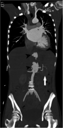 (A) Chest radiograph shows cardiomegaly and an abnormal left paraspinal density in the region of the descending thoracic aorta (arrow). (B, C and D) Coronal contrast-enhanced computed tomographic angiography images of the chest, abdomen and pelvis reveal a diffuse abnormal appearance of the descending thoracic aorta and suprarenal abdominal aorta with lumen irregularity, wall thickening and/or mural thrombus as well as multiple aneurysms (arrowheads). Lack of contrast opacification of the left renal artery and delayed enhancement of the left kidney (white arrow) secondary to renal artery stenosis or thrombosis.