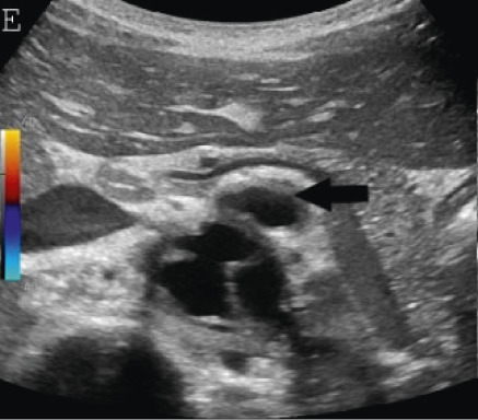 (A,B,C,D) Transverse and sagittal gray-scale and color Doppler ultrasound images of the upper abdominal aorta (white arrow) and (E,F) transverse gray-scale and color Doppler ultrasound images of the superior mesenteric artery (black arrow) show wall thickening and/or mural thrombus, lumen irregularity, and multiple aneurysms. (G,H) Transverse Gray-scale and color Doppler ultrasound images of the abdominal aorta and left renal artery (yellow arrow) show ostial narrowing of the left renal artery.