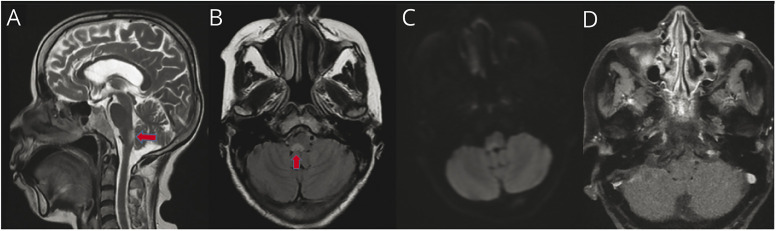 Area Postrema Syndrome: An Initial Presentation of Double-Seropositive ...