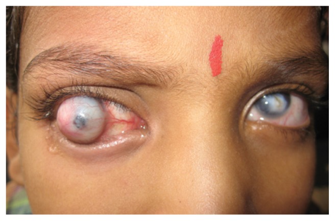 Management of pediatric corneal limbal dermoids - PMC