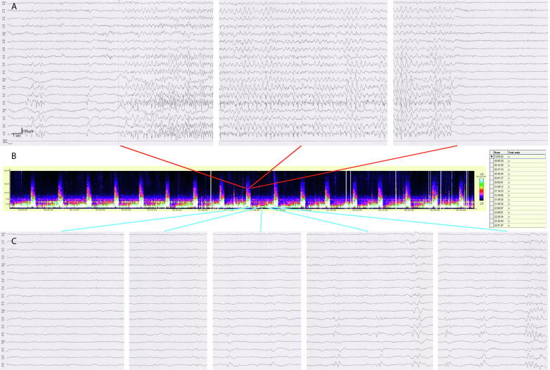 Periodic electroclinical seizures following an ischemic stroke revealed