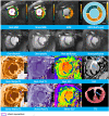Myocardial infarction (purple circle) with corresponding rest and
stress cine MRI, perfusion, T1 mapping, and late gadolinium enhancement
(LGE) images and 2, 3, 5-triphenyltetrazolium (TTC) staining. A region is
highlighted in the LGE image, with pale coloring in the corresponding area
on the TTC image (arrows). ECV = extracellular volume, MBF = myocardial
blood flow, MPR = myocardial perfusion reserve.