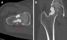 CT of the right hip with coronal (A) and oblique axial (B) images