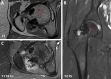 MRI of the right hip with axial (A), coronal (B) and axial images after administration of IV‑contrast (C)