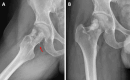 Conventional radiography of the right hip in exorotation (A) and AP (B)