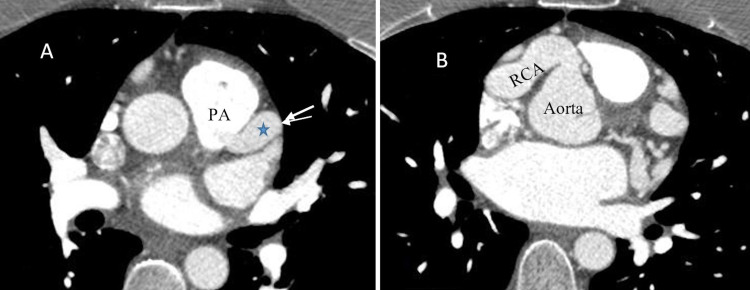 Adult Anomalous Left Coronary Artery Arising From the Pulmonary Artery ...