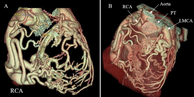 Adult Anomalous Left Coronary Artery Arising From the Pulmonary Artery ...