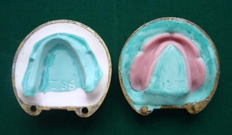 Figure 5: Denture Flask after trial closure for Water Bath Curing.