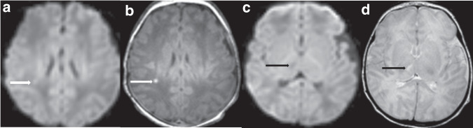 Mild hypoxic-ischemic encephalopathy (HIE): timing and pattern of MRI ...