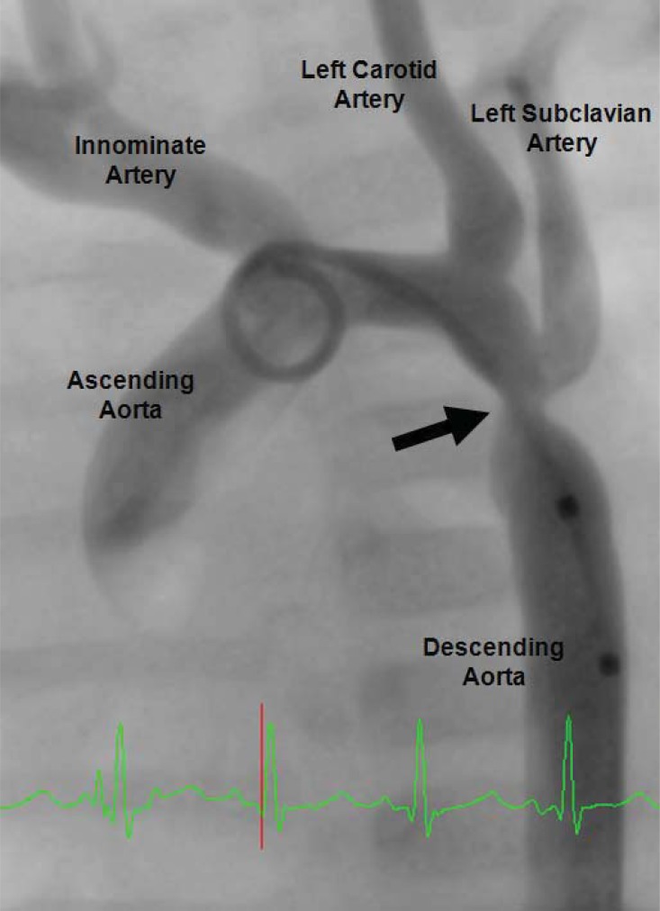 Coarctation of the Aorta - The Current State of Surgical and ...