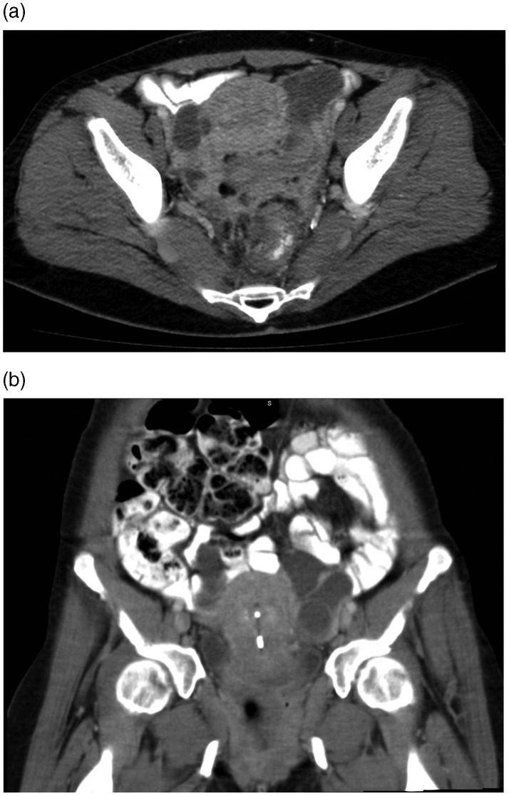 Abdominopelvic Actinomycosis Spectrum Of Imaging Findings And Common