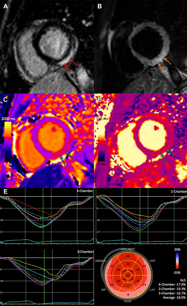 Basal short-axis 1.5-T cardiac MR images demonstrate (A) subepicardial late gadolinium enhancement at the basal inferior and inferior lateral wall (red arrows), with corresponding (B) hyperintensity on T2-weighted image (orange arrows), (C) abnormal high regional native T1 (1123 msec, blue arrows [upper reference range, 960 msec]), and (D) abnormal high regional T2 (58 msec, green arrows [upper reference range, 51 msec]). These findings are in keeping with acute myocarditis based on the revised Lake Louise criteria. Global systolic function was impaired (left ventricular ejection fraction, 48%), with hypokinesis of the basal inferolateral wall. (E) Speckle-tracking echocardiography–based global longitudinal strain demonstrates reduced strain involving most basal segments (global longitudinal strain, −18%).