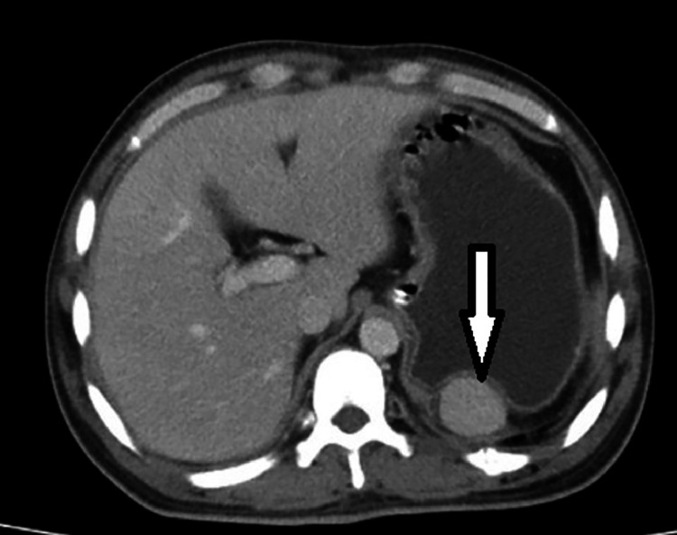 Multiple Intra Abdominal Splenosis With Imaging Correlative Findings A