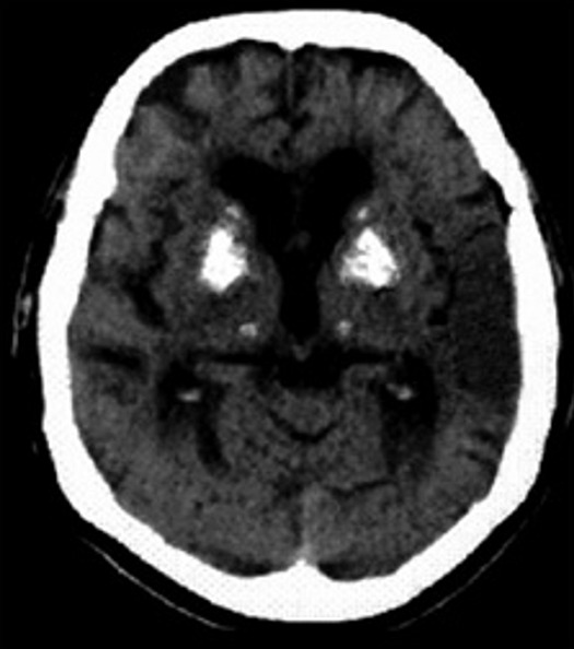 Accident vasculaire c r bral isch mique r v lant un syndrome de fahr pmc