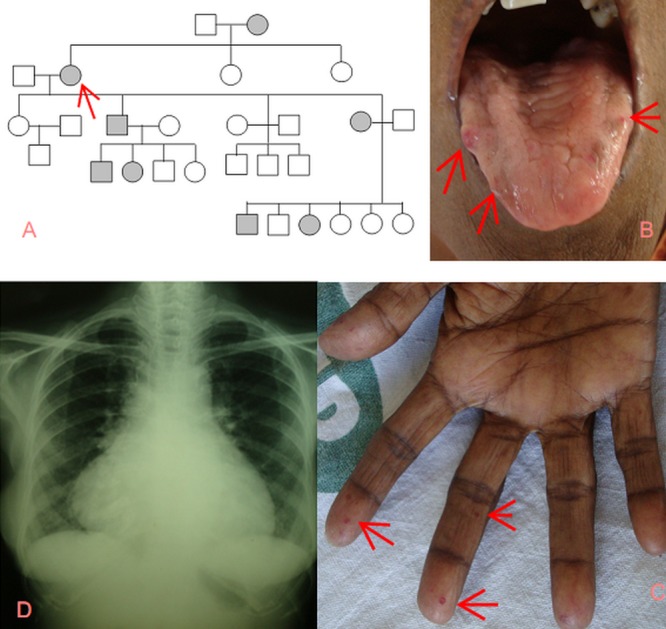 Hereditary Hemorrhagic Telangiectasia With Unusual Associations PMC hereditary-hemorrhagic-telangiectasia-with-unusual-associations-pmc
