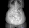 CT abdomen shows Ogilvie syndrome effects with dilated large intestine, primarily rectum and ascending colon, no blockages spotted.