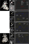 Flow assessment in a 15-year-old patient with double-outlet right
ventricle and pulmonary atresia after extracardiac Fontan procedure. Flows
are assessed by imaging the vessel perpendicular to its long axis using
phase-contrast imaging. Through-plane velocity maps of the ascending aorta,
superior vena cava (SVC), inferior vena cava (IVC), right pulmonary artery
(RPA), left pulmonary artery (LPA), right pulmonary veins (RPVs), and left
pulmonary veins (LPVs) are shown. The pulmonary arteries appear unobstructed
(RPA:LPA net flow split ratio, approximately 60%:40%). Estimated
systemic-to-pulmonary collateral flow is approximately 10% (systemic
estimator: AO − [SVC + IVC]; pulmonary estimator: [RPV + LPV]
− [RPA + LPA]).