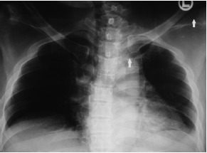 Fig. 1: Chest radiograph showing dislocation of both ends of
the clavicle (arrows).