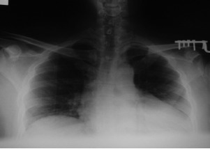 Fig. 2: Left clavicle reduced after operative procedure. The
symmetry between the right and the left articular spaces
can be observed.