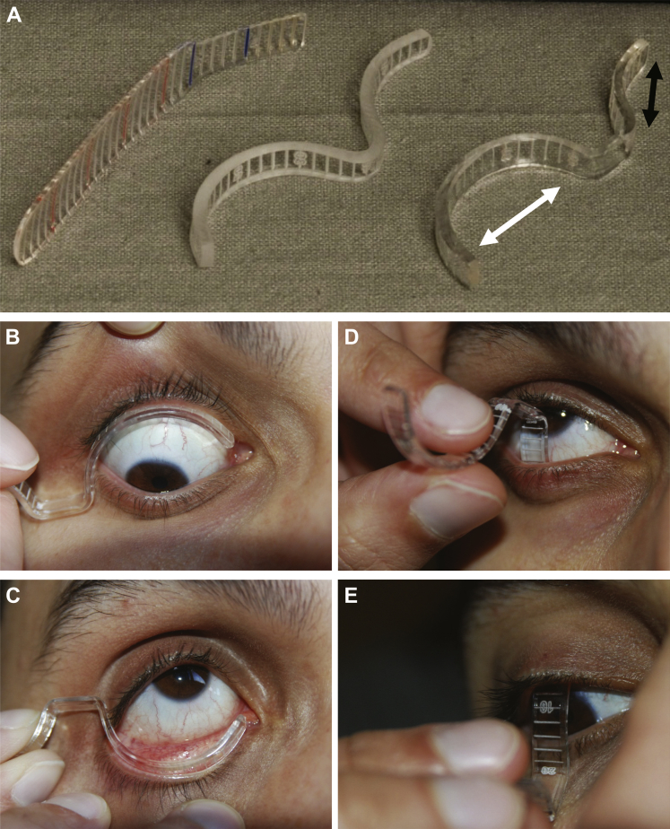 Defining the Limits of Normal Conjunctival Fornix Anatomy in a Healthy ...