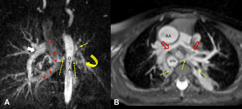 (A) Coronal maximum intensity projection of multiphase contrast-enhanced MR angiographic image in a 6-year-old girl with total anomalous pulmonary venous return (course marked with red ★s), ventricular septal defect, and hypoplastic left pulmonary artery (yellow curved arrow). Few major aortopulmonary collateral arteries (dotted yellow arrows) arising from the descending thoracic aorta were observed supplying right lower lobe and left upper and lower lobes. The left-sided pulmonary veins were not adequately opacified in this phase but were of normal size in subsequent phases, suggesting slow flow to left lung. The right pulmonary artery was of normal caliber (white arrow). (B) Axial maximum intensity projection of non–contrast-enhanced balanced steady-state free precession angiographic image in a 2-year-old boy with tetralogy of Fallot shows hypoplastic central pulmonary arteries (red open arrows) and multiple major aortopulmonary collateral arteries (yellow dotted arrows) arising from descending thoracic aorta (DTA) directly supplying lung and communicating with native pulmonary artery. AA = ascending aorta.