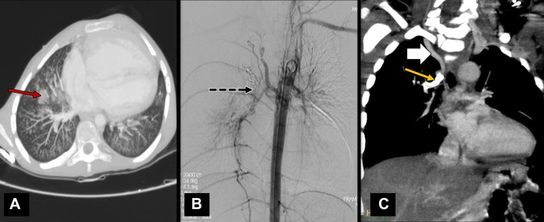 (A) CT and (B) digital subtraction angiographic images in a 14-year-old boy with tetralogy of Fallot and associated pulmonary infundibular stenosis. The child presented with hemoptysis with lung parenchyma showing areas of pulmonary hemorrhage (red arrow in A) in right lung. (B) Descending thoracic aortic angiographic image shows the major aortopulmonary collateral arteries (MAPCAs) arising at D6 level that were embolized using vascular coils (black dotted arrow). (C) Coronal oblique projection of cardiac CT angiographic image in an 8-year-old boy with pulmonary atresia with ventricular septal defect shows a large collateral vessel from right subclavian artery (white solid arrow) supplying right upper lobe. The descending segment of this collateral vessel was narrowed and had a stent placed (yellow arrow) to maintain saturation, as central pulmonary arteries were poorly developed.