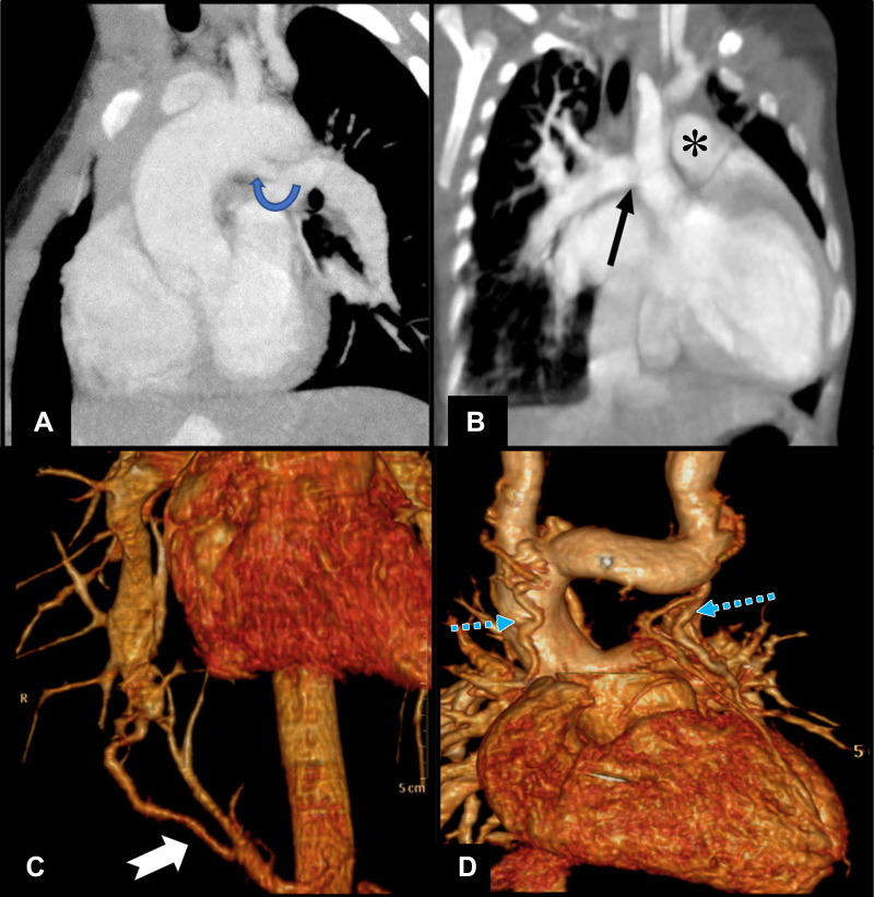 (A) Sagittal oblique cardiac CT section in a 1-year-old boy shows patent ductus arteriosus (rounded arrow) draining into left pulmonary artery in a case of pulmonary atresia and ventricular septal defect. (B) Coronal oblique cardiac CT image shows right pulmonary artery (black arrow) arising from aorta in a 4-month-old girl, suggestive of hemitruncus. There was coexisting main pulmonary artery (*) supply to left lung. (C) Volume-rendered cardiac CT image shows isolated pulmonary supply from aorta (white tailed arrow) to lung parenchyma in a 26-year-old man who presented with hemoptysis and no structural heart disease, suggestive of type B malinosculation. (D) Coronal projection of CT angiographic image in volume-rendered reconstruction (excluding anterior ascending aorta for visibility) in a 7-year-old boy with double-outlet right ventricle after staged hemi-Fontan surgery shows small vessels in mediastinum with tortuous courses (blue dotted arrows) having communication with superior caval vein or its tributaries and veins draining into azygous vein, suggestive of venovenous collaterals.