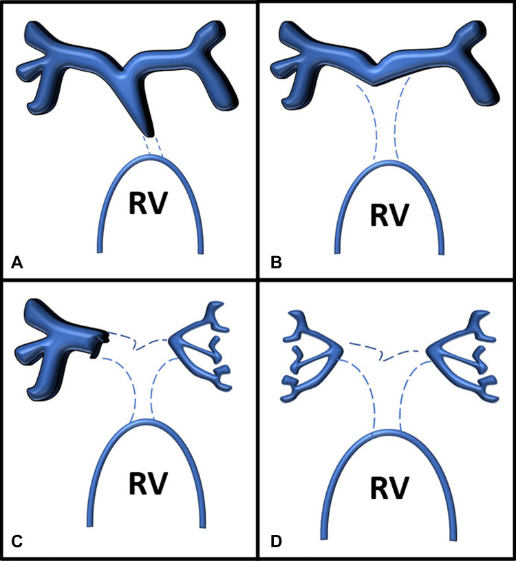 Somerville classification of pulmonary arterial anatomy in pulmonary atresia with ventricular septal defect. (A) Type 1, atresia of pulmonary valve. (B) Type 2, atresia of pulmonary valve and main pulmonary artery. (C) Type 3, atresia of pulmonary valve, main pulmonary artery, and one main branch. (D) Type 4, atresia of the pulmonary valve, main pulmonary artery, and both main pulmonary artery branches. RV = right ventricle.