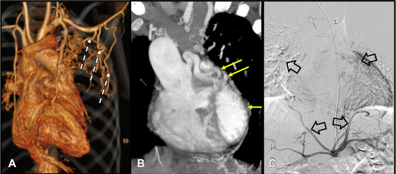 (A) Volume-rendered CT image in a 10-year-old boy with atrioventricular canal defect and pulmonary stenosis shows the prominent collateral vessels from the left subclavian artery and left internal mammary artery (white dotted arrows). (B) Coronal maximum intensity projection CT image in a 7-year-old boy with double-outlet right ventricle and pulmonary stenosis shows dilated left coronary artery (yellow arrows) supplying the left lung. (C) Digital subtraction angiographic image in same patient as (B) of the celiac artery ostium shows hypertrophied inferior phrenic branches supplying bilateral lung parenchyma (black open arrows).