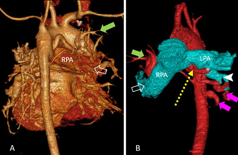 (A) Volume-rendered reconstruction image in posterior projection shows branching of native pulmonary artery and major aortopulmonary collateral arteries (MAPCAs) in a 9-year-old girl with tetralogy of Fallot and shows predominant supply to right upper lobe from native pulmonary artery (open arrow) along with a MAPCA (green solid arrow). (B) Volume-rendered reconstruction image in anterior projection shows aorta and MAPCA colored in red and pulmonary branches in cyan color with predominant supply of left lower lobe by MAPCA (magenta solid arrows) than by native left pulmonary artery (white arrow head). A communicating collateral (yellow dotted arrow) was observed joining the native left pulmonary artery at hilum from its inferior surface (*). Supply to right upper lobe from native pulmonary artery (open arrow) and MAPCA (green solid arrow) are also labeled.