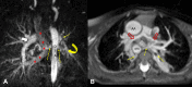(A) Coronal maximum intensity projection of multiphase contrast-enhanced
MR angiographic image in a 6-year-old girl with total anomalous pulmonary venous
return (course marked with red ★s), ventricular septal defect, and
hypoplastic left pulmonary artery (yellow curved arrow). Few major
aortopulmonary collateral arteries (dotted yellow arrows) arising from the
descending thoracic aorta were observed supplying right lower lobe and left
upper and lower lobes. The left-sided pulmonary veins were not adequately
opacified in this phase but were of normal size in subsequent phases, suggesting
slow flow to left lung. The right pulmonary artery was of normal caliber (white
arrow). (B) Axial maximum intensity projection of non–contrast-enhanced
balanced steady-state free precession angiographic image in a 2-year-old boy
with tetralogy of Fallot shows hypoplastic central pulmonary arteries (red open
arrows) and multiple major aortopulmonary collateral arteries (yellow dotted
arrows) arising from descending thoracic aorta (DTA) directly supplying lung and
communicating with native pulmonary artery. AA = ascending aorta.