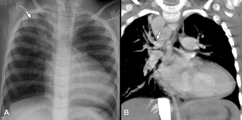 (A) Chest radiograph in frontal projection of a 4-year-old girl with long segment pulmonary atresia and ventricular septal defect shows markedly increased vascularity involving the right upper zone (white arrow) in comparison with rest of the lung showing normal or mildly reduced vascularity. (B) Correlation with coronal CT image shows dilated major aortopulmonary collateral arteries (white arrow) independently supplying the right upper lobe segments. Child also had a right-sided aortic arch.