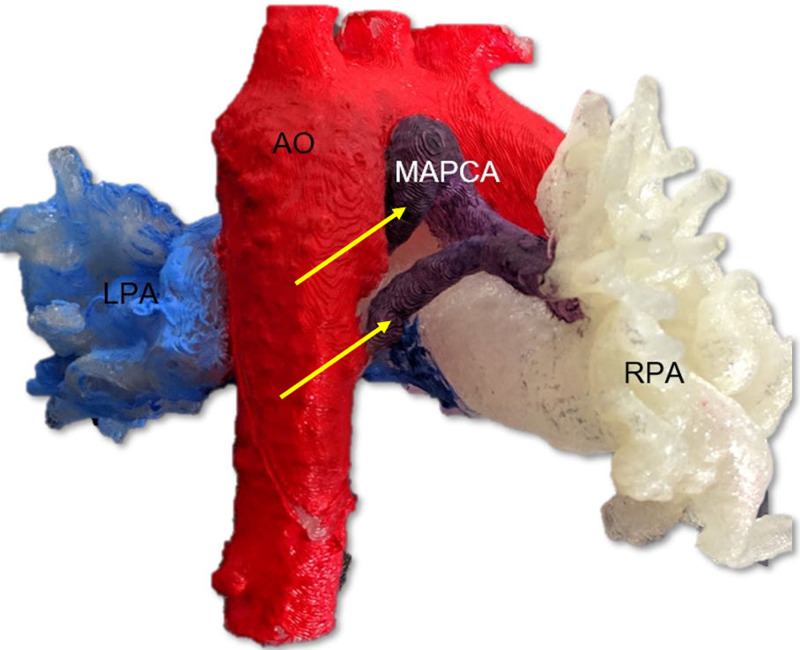 A three-dimensional printed model in right-posterior projection from a patient with pulmonary atresia with ventricular septal defect with major aorto-pulmonary collateral arteries (MAPCA; yellow arrows) arising from the aorta (Ao; colored in red), shown in relation to the right pulmonary arteries (RPA; white color) and left pulmonary arteries (LPA; light blue color), aided in surgical planning prior to unifocalization.