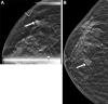 Images in a 68-year-old woman with a history of benign excisional biopsy
performed during breast cancer screening. (A) Diagnostic mammogram (synthetic
mammography, craniocaudal view) shows new calcifications and an adjacent mass
(arrow). At subsequent biopsy, an estrogen receptor–positive,
progesterone receptor–positive, intermediate-grade ductal carcinoma in
situ is identified. At this time, the patient underwent lumpectomy and radiation
therapy. (B) Surveillance mammogram (synthetic mammography, craniocaudal view)
obtained 3 years after A shows a new spiculated mass (arrow). Subsequent biopsy
revealed an estrogen receptor–positive, progesterone
receptor–positive, human epidermal growth factor receptor
2–negative, intermediate-grade invasive ductal carcinoma.