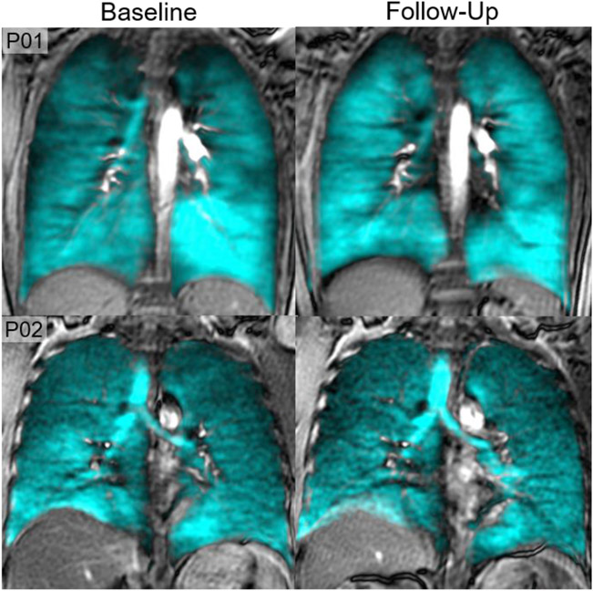 Pulmonary Functional MRI: Detecting the Structure-Function Pathologies ...