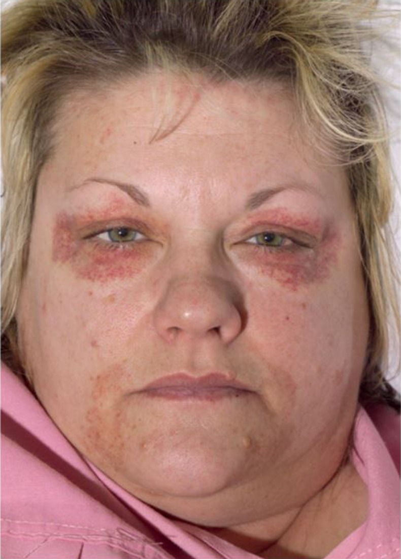 Recurrent bilateral periorbital and circumoral bruising due to vomiting