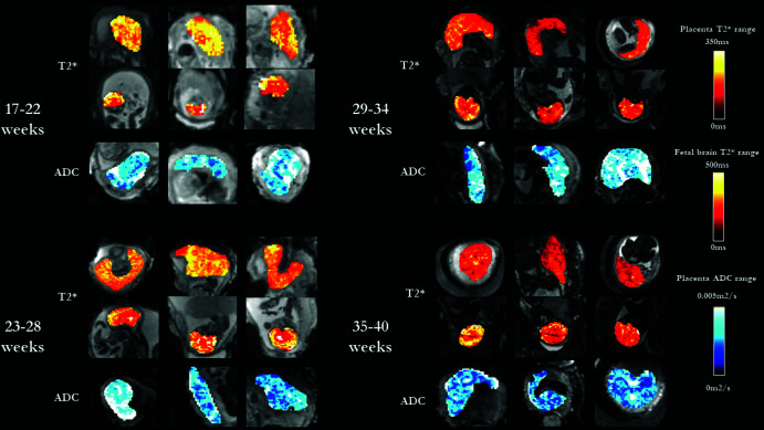 Images show quantitative T2* maps and apparent diffusion coefficient (ADC) maps for gestational age, split into four ranges: 17–22 weeks, 23–28 weeks, 29–34 weeks, and 35–40 weeks. T2* maps are overlaid over the data from the second echo time and the ADC maps over the data acquired at b = 0 m/sec2. Derived quantitative maps displayed a pattern of high T2* in the lobule centers (yellow) with reduced T2* in the placental septa and toward the periphery of the placenta.