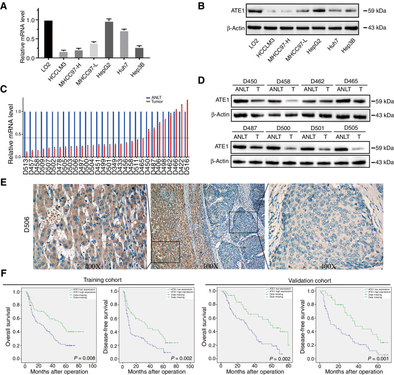 Figure 1. ATE1 is frequently downregulated and predicts poor prognosis in HCC. ATE1 expression was downregulated in HCC cell lines analyzed by real-time PCR (A) and Western blot (B). C, ATE1 mRNA level was detected in 30 pairs of HCC tissues and their adjacent nontumor liver tissues (ANLT) by real-time PCR. Imaginary line indicates the mean fold change. D, 8 of the 30 pairs of HCC tissues and their ANLTs were selected randomly and ATE1 expression was detected by Western blot analysis. E, Representative IHC images of ATE1 expression also showed that ATE1 expression was lower in tumor tissues than in ANLTs. Magnification, 100×, inset magnification, 400×. F, Kaplan–Meier curves for OS and DFS according to ATE1 expression in the training cohort (n = 120) and validation cohort (n = 80).