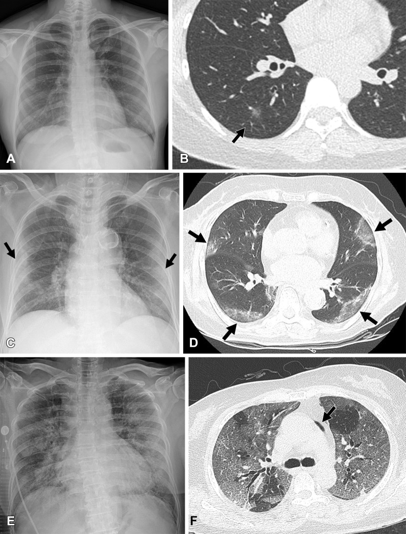 Chest radiographic and CT findings of COVID-19 pneumonia according to disease stage and lesion extent. (A, B) COVID-19 pneumonia at the time of “early infection phase” in a 42-year-old woman who received a booster dose during Omicron variant–dominant period. (A) Chest radiograph obtained 3 days after the positive nucleic acid amplification test shows no abnormal opacification in either lung. (B) Transverse nonenhanced CT scan (lung window) obtained at level of basal trunk and on the same day shows an ill-defined ground-glass opacity (GGO) nodule (arrow) in the superior segment of the right lower lobe. (C, D) COVID-19 pneumonia at the time of “pulmonary phase” in an 80-year-old fully vaccinated woman during Delta variant–dominant period. (C) Chest radiograph obtained 5 days after positive nucleic acid amplification test shows multifocal patchy consolidation and GGO (arrows) in both lungs with a peripheral predominance. (D) Transverse nonenhanced CT scan (lung window) obtained at the level of the inferior pulmonary vein and on the same day demonstrates patchy areas of mixed GGO and consolidation with subpleural distribution (arrows). (E, F) COVID-19 pneumonia at the time of “hyperinflammatory phase” in a 69-year-old unvaccinated woman with no underlying disease during Delta variant–dominant period. (E) Chest radiograph obtained 2 weeks after positive nucleic acid amplification test shows diffuse and extensive parenchymal opacity involving bilateral lungs. (F) Transverse nonenhanced CT scan (lung window) obtained at the level of carina and on the same day demonstrates diffuse and extensive areas of GGO with visible intralobular lines involving bilateral lungs. Also note pneumomediastinum at left paraaortic area (arrow). Even though the patient was treated with mechanical ventilation and extracorporeal membrane oxygenation, she succumbed to the disease.