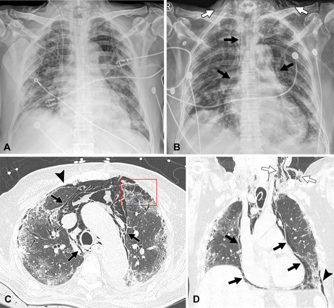 Images of COVID-19 pneumonia with oxygen toxicity and barotrauma at the time of Delta variant–dominant period in a 71-year-old unvaccinated man with diabetes. (A) Chest radiograph obtained 10 days after positive nucleic acid amplification test for COVID-19 shows extensive parenchymal opacity involving bilateral lungs. He was transferred to the intensive care unit due to worsening of hypoxemia and was given mechanical ventilation with prolonged oxygen supply. (B) Follow-up chest radiograph obtained 25 days after initial diagnosis of COVID-19 demonstrates identifiable pneumomediastinum (black arrows) and subcutaneous emphysema (white arrows) with parenchymal opacities. (C) Transverse and (D) coronal reformatted images of nonenhanced CT scans depict mixed ground-glass opacity, consolidation, and reticulation in the peripheral areas of both lungs associated with interstitial emphysema (small arrows in C) causing Macklin effect, pneumothorax (arrowhead), pneumomediastinum (black arrows) and subcutaneous emphysema (white arrows in D). Note air cysts in the anterior left lung (box in C). One month after receiving mechanical ventilation with corticosteroid treatment, the patient recovered and was discharged.