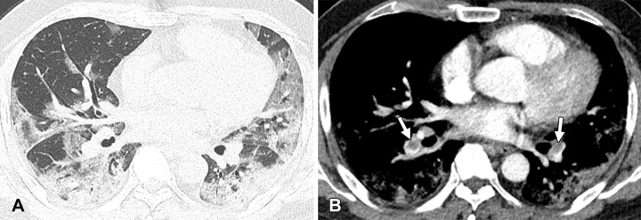 Pulmonary embolisms in a 47-year-old unvaccinated diabetic man with COVID-19 seen at Omicron variant–dominant period. (A) Transverse nonenhanced CT scan (lung window) obtained at the level of basal trunks shows bilateral mixed areas of ground-glass opacity and consolidation distributed along bronchovascular bundles or subpleural lungs. (B) Contrast-enhanced CT scan (mediastinal window) obtained at a similar level to A demonstrates nonocclusive clots in bilateral basal trunk arteries (arrows) along with lung parenchymal lesions.